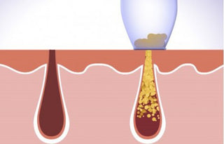 Derma Suction - porentief reiner Haut